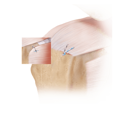 骨盤骨折　Surgical technique Arthroscopic Bony Bankart Lesion Fixation Using Knotless